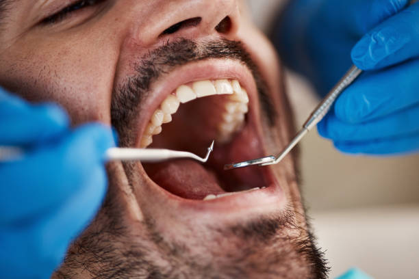 Best Emergency Tooth Extraction in Orinda, CA