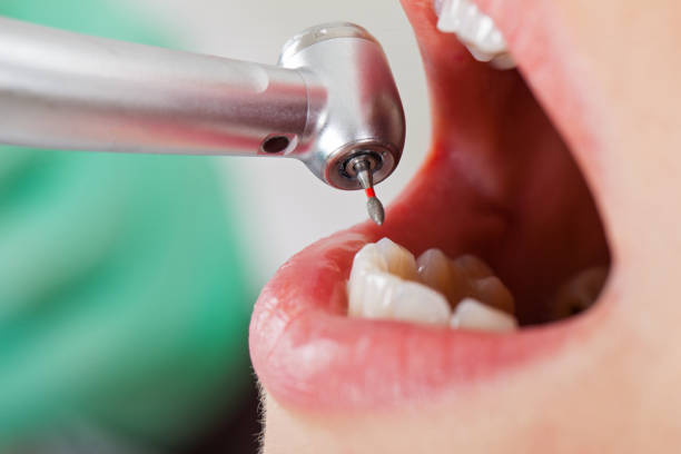 Best Emergency Root Canal Treatment in Orinda, CA